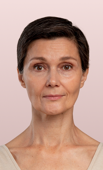 Before and after results of a lip filler treatment at Desert Med Rejuvenation. Individual results may vary.